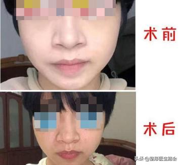 鼻头缩小后鼻孔里增生了,鼻头鼻翼缩小疤痕增生怎么办