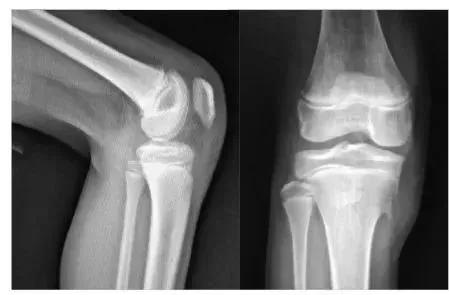 青少年膝盖疼骨骺炎怎么缓解,胫骨结节骨软骨炎怎么缓解疼痛