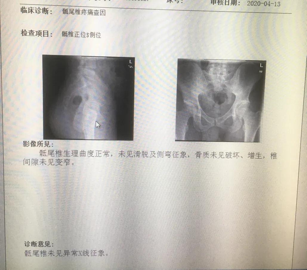 痔疮外痔形成原因,痔疮的形成和治疗