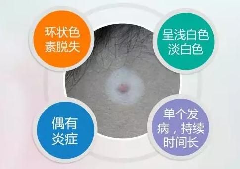 什么是晕痣和白癜风,晕痣型白癜风和白癜风有什么区别