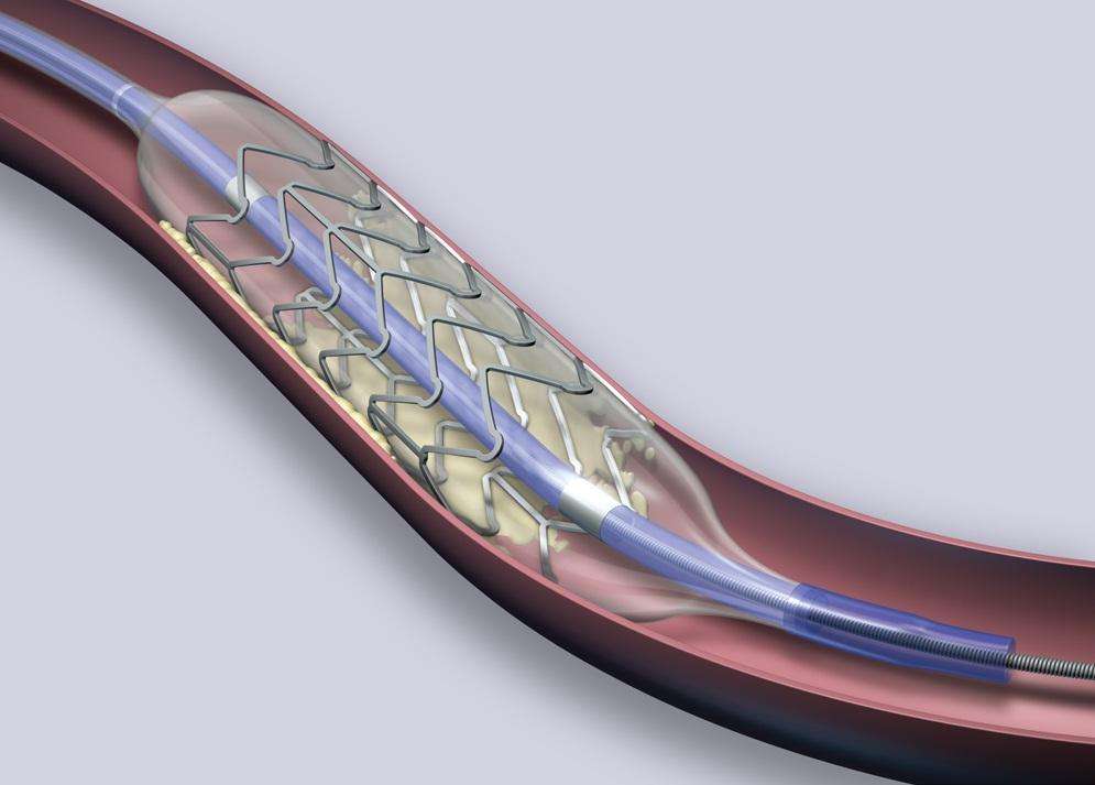 心梗放支架后能恢复到正常状态吗,心梗不严重不建议放支架