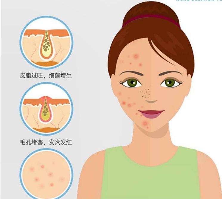 闭合性粉刺到底有多难治？看完本文你就完全清楚了