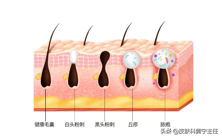 痘痘肌女孩必看,油痘肌必须知道的