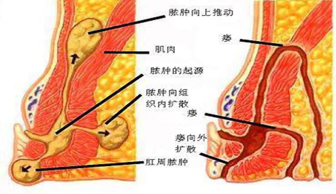 肛瘘手术比生孩子还疼吗,肛瘘手术疼痛可以承受吗