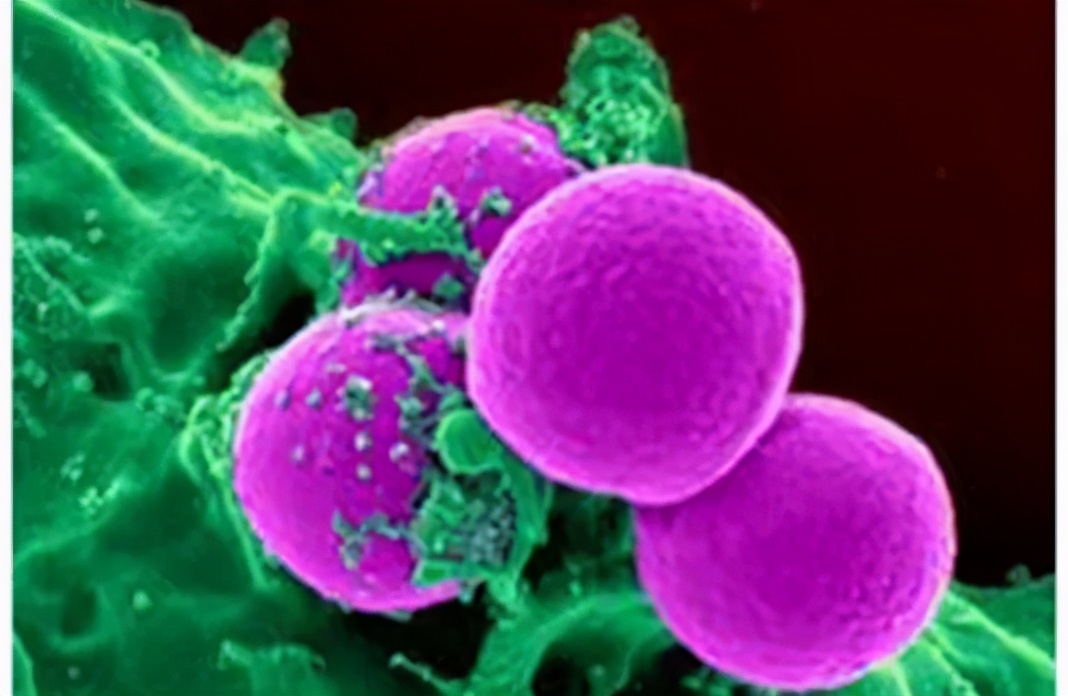 囊肿癌变最严重会怎么样,囊肿切除了又复发是癌变吗