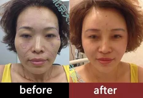 娄艺潇填充脂肪前后对比,娄艺潇填充前后对比