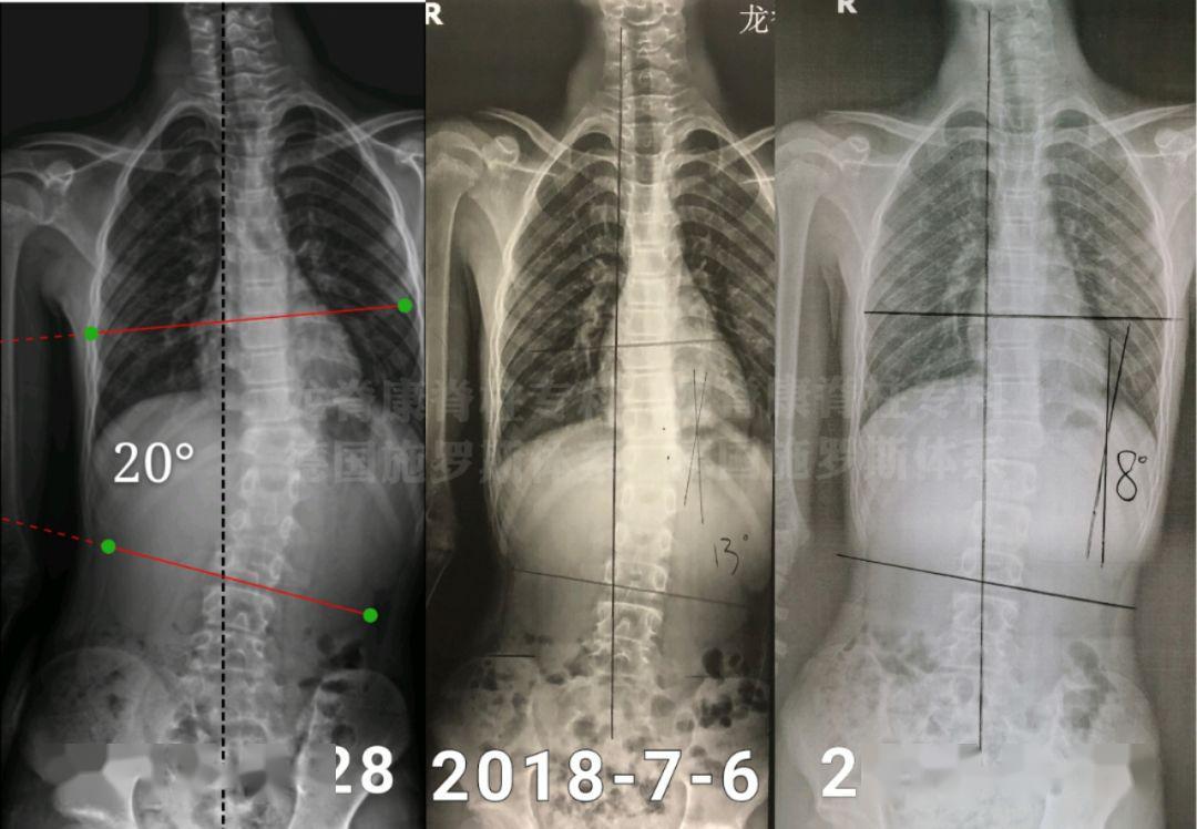 最常见的先天性脊柱侧凸的病因,先天性脊柱凸起怎么治疗