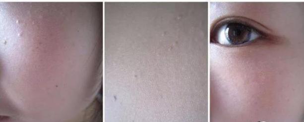 脂肪粒去粒神器 (日本自动消除脂肪粒)