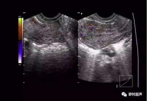 盆底超声可检查什么疾病,哪些疾病需要做妇科检查