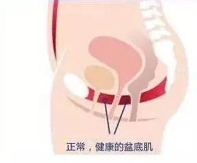 剖腹产需要对盆底肌进行修复吗,剖腹产可以避免子宫脱垂吗