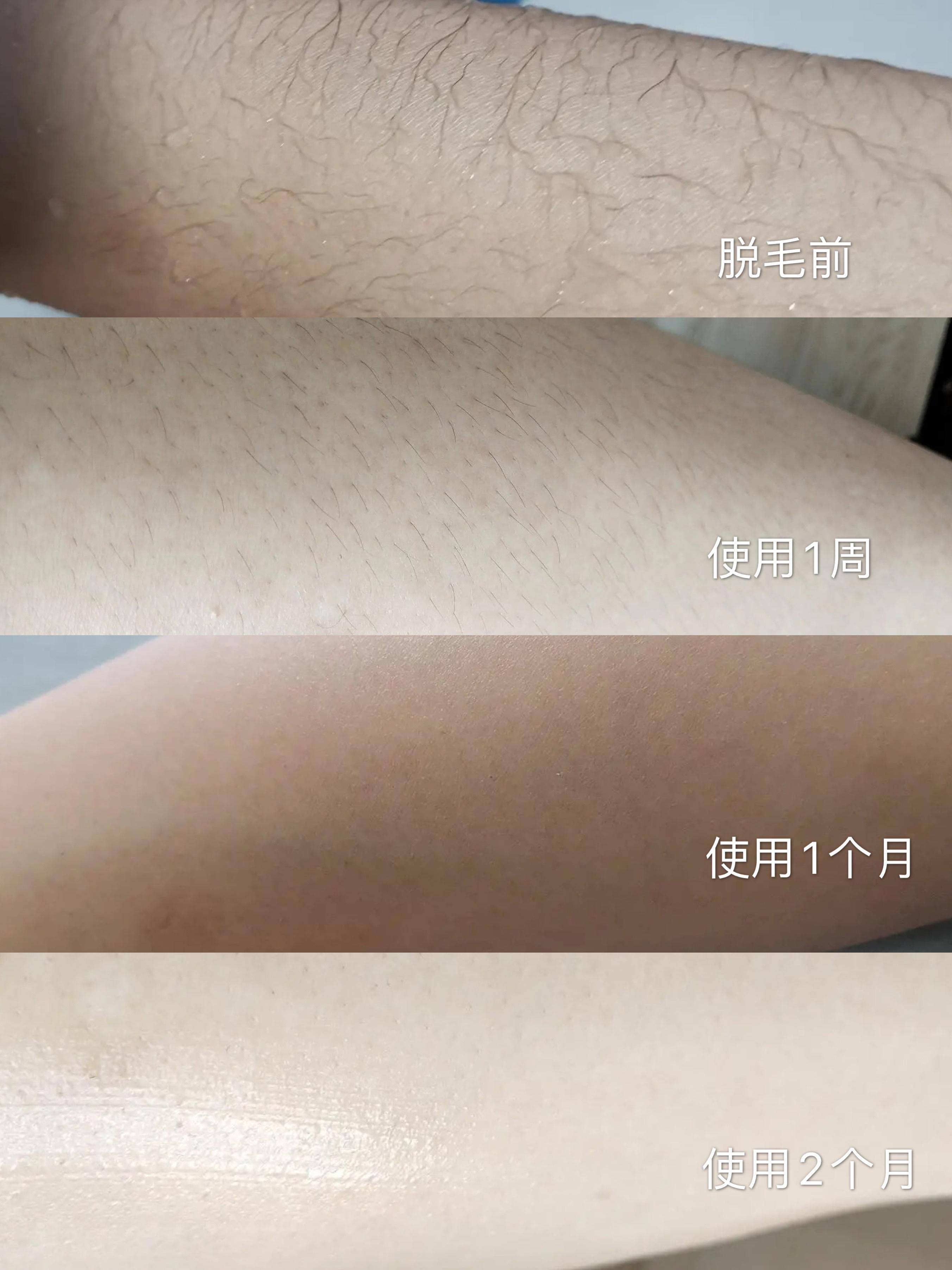 脱毛仪用了一年感觉没什么效果,脱毛仪用了一个多月还是长得很快