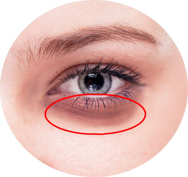 去熬夜型黑眼圈,去黑眼圈眼袋熬夜党福音