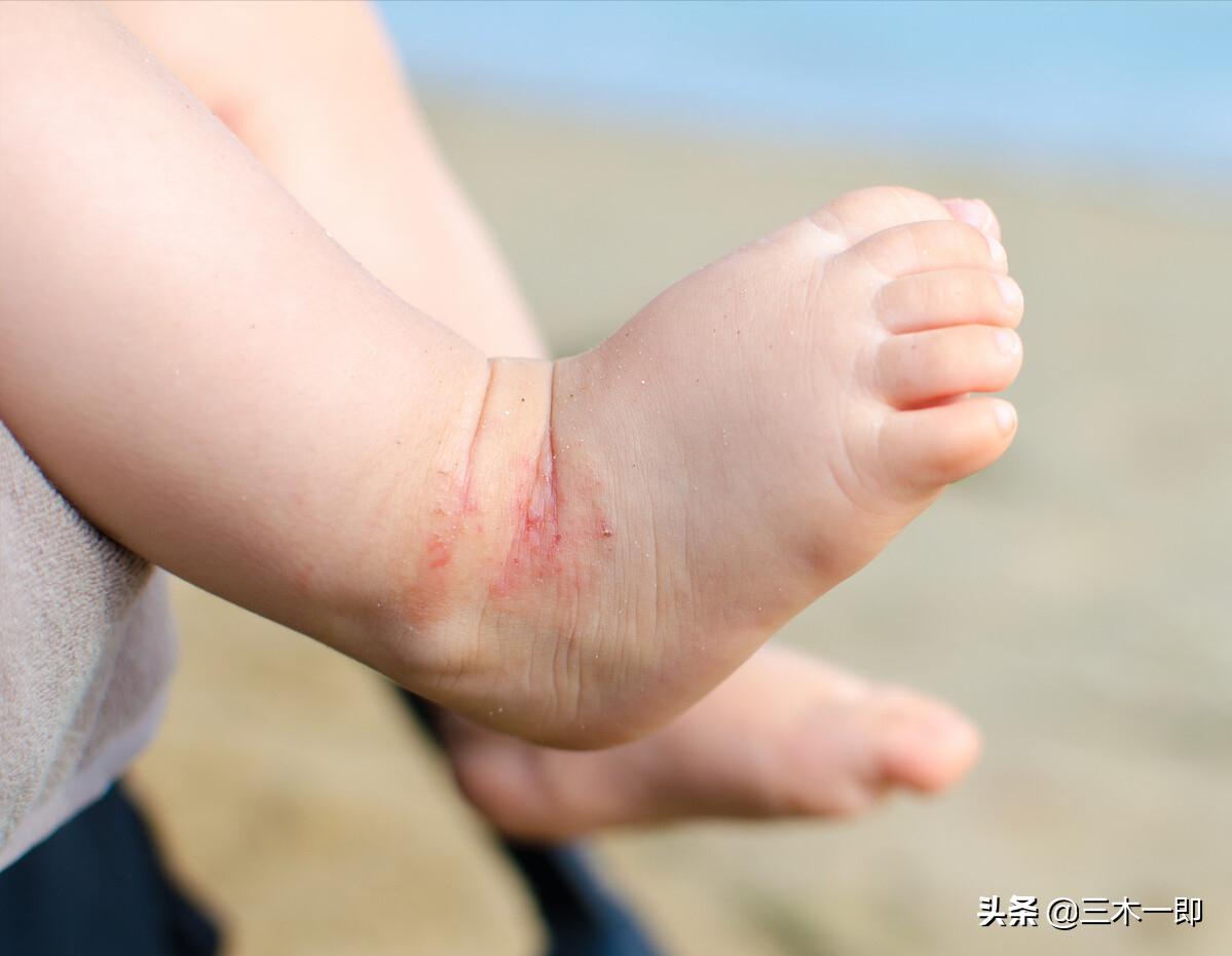 湿疹治愈以后生活注意事项,简单学会一招搞定婴儿湿疹