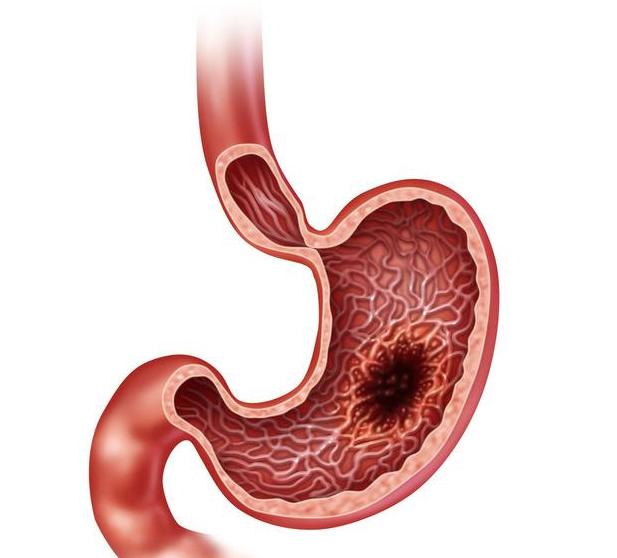 消化不良胃胀胃痛吃什么药,胃溃疡胃胀反反复复