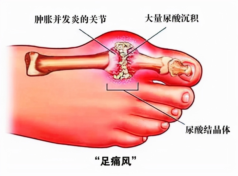 得了痛风需要注意哪些,痛风发作是要多走路还是少走路