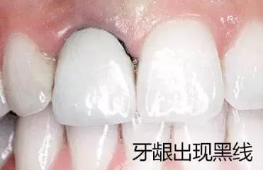 烤瓷牙套里的牙烂了有什么症状,烤瓷牙牙套里的牙烂了怎么处理