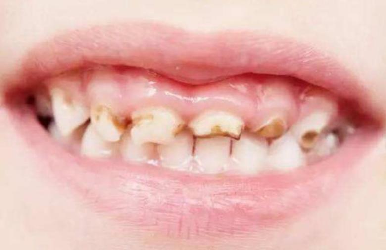 儿童大牙龋齿严重该怎么办,儿童牙有龋齿应该怎么治疗