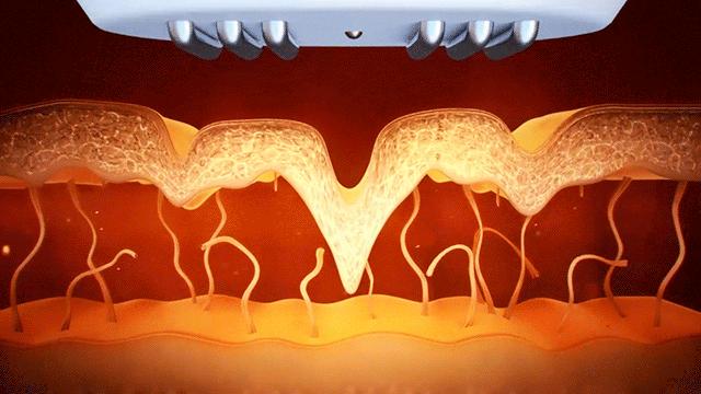 轻松学会选择正确的美容仪,美容仪器工作坑