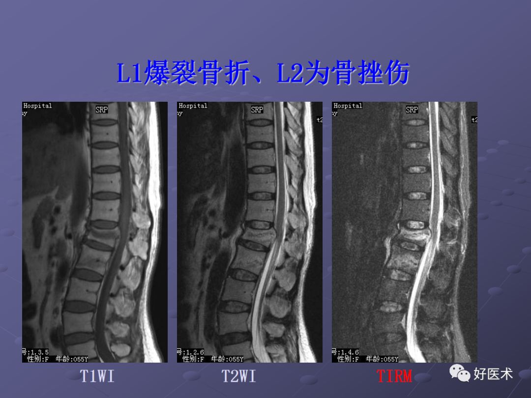 脊柱mri有哪些特点,乳腺疾病的mri诊断及鉴别