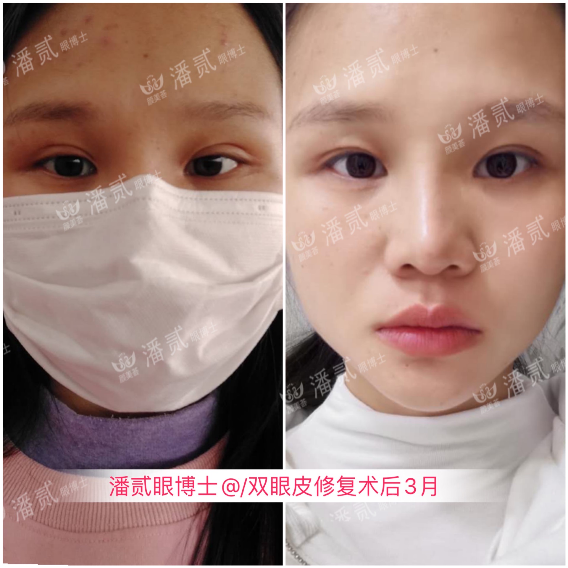 割双眼皮和眉骨有关系吗,做双眼皮想要圆眼割什么样的