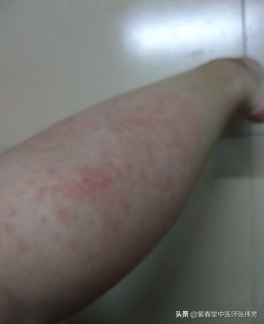 过敏性紫癜红点多长时间可以消退,过敏性紫癜红点消退后还需要忌口