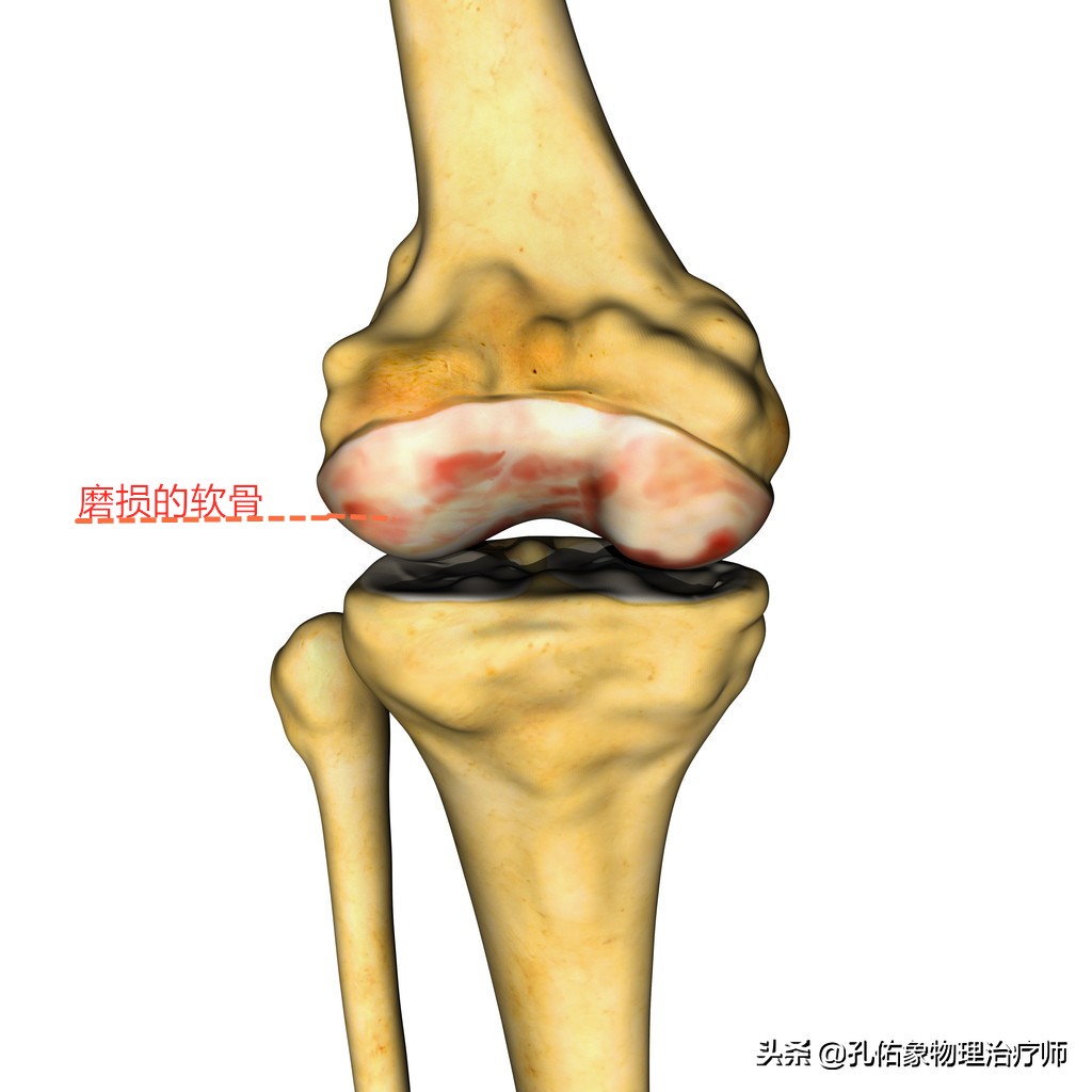 膝盖上下楼梯痛的治疗方法,直腿抬高膝关节弹响疼痛怎么治疗