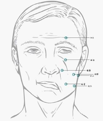 中医治疗面瘫后遗症的特效方,治疗面瘫中医好还是西医好