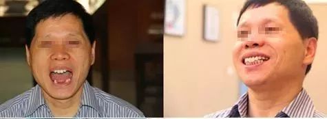 国家有关于牙齿的补贴吗,牙齿补贴报销政策