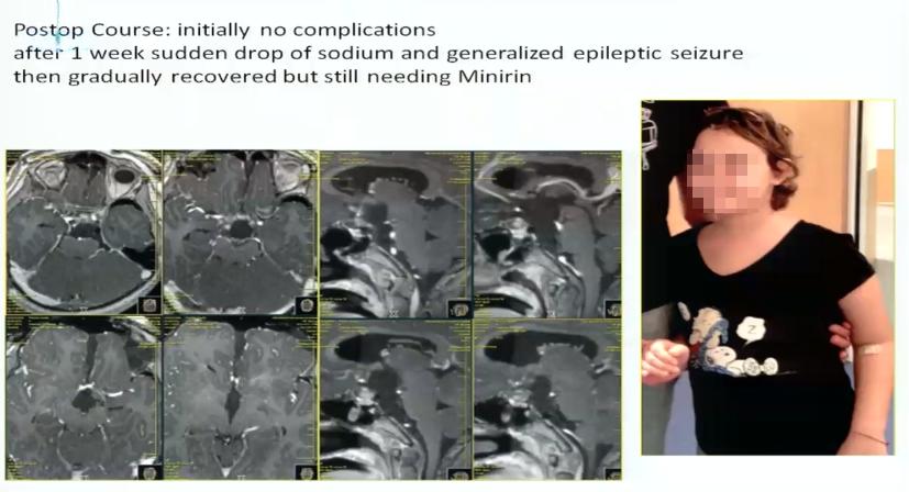 INC巴特朗菲教授视频|视神经-下丘脑胶质瘤全切案例集及治疗解读