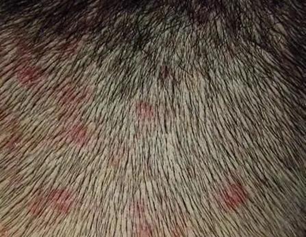 皮肤油就是脂溢性皮炎吗？