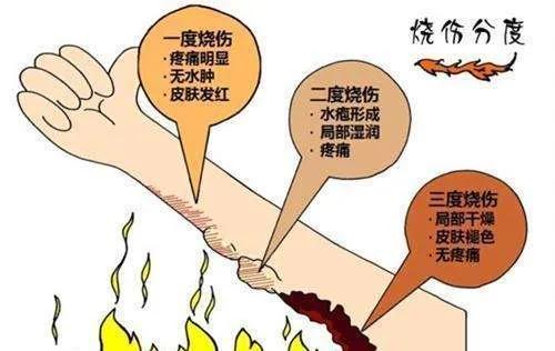 重疾险产品中“Ⅲ度烧伤”的理赔实务及探讨