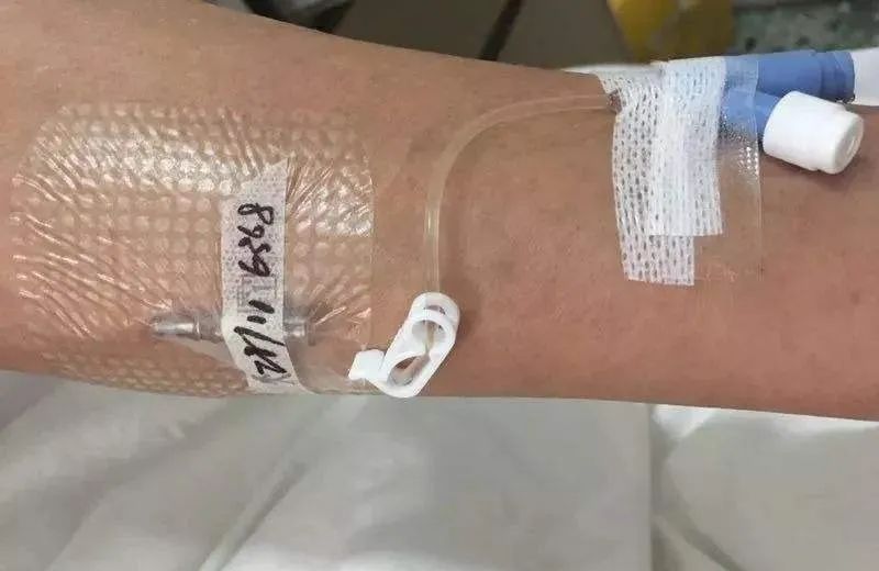 关于留置针的科普,留置针的四大注意事项