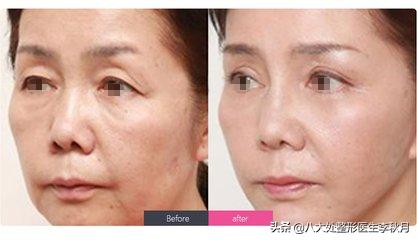 眼部细纹和眼袋泪沟怎么去除,赶走泪沟眼袋眼干没细纹