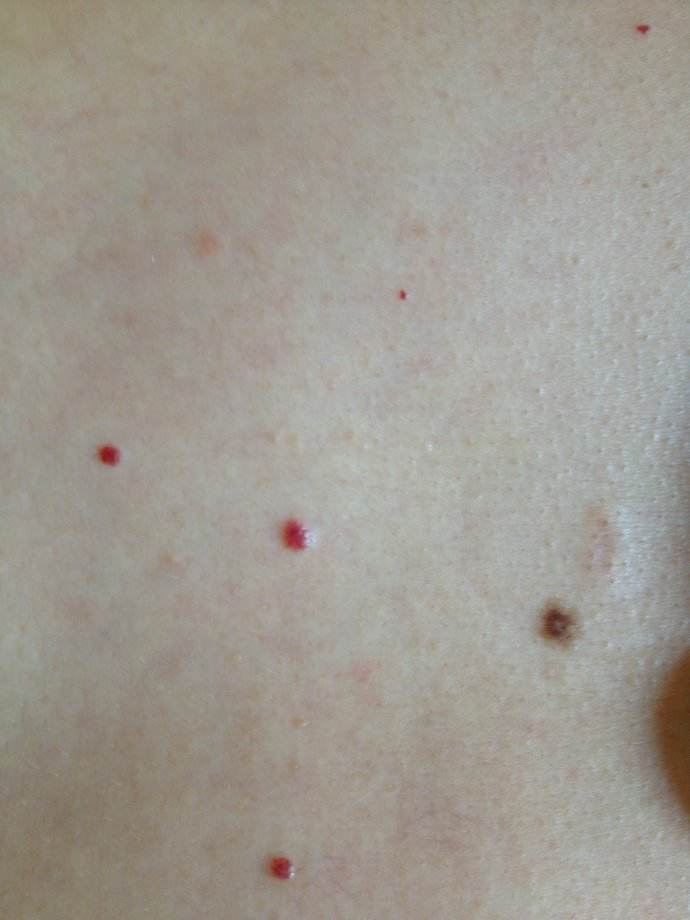 点痣有讲究吗哪里的痣不能点,点痣真的影响自身风水吗