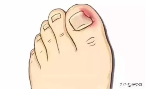 夏天艾灸好还是冬天艾灸好,春天艾灸好还是夏天艾灸好