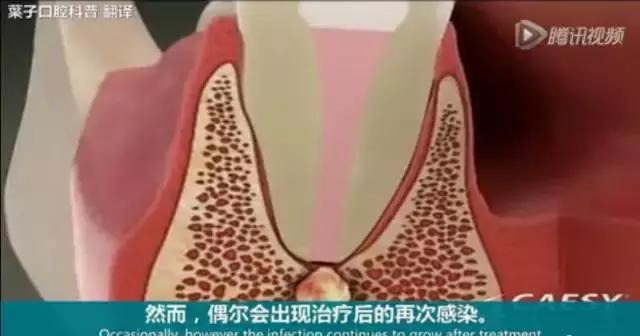 上牙龈上火突出一个鼓包,牙龈肿胀鼓包上火了吗