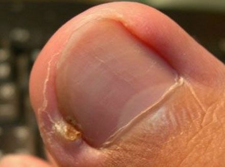 手指倒刺甲沟炎的症状及图片,手指甲沟炎是不是异物引起的