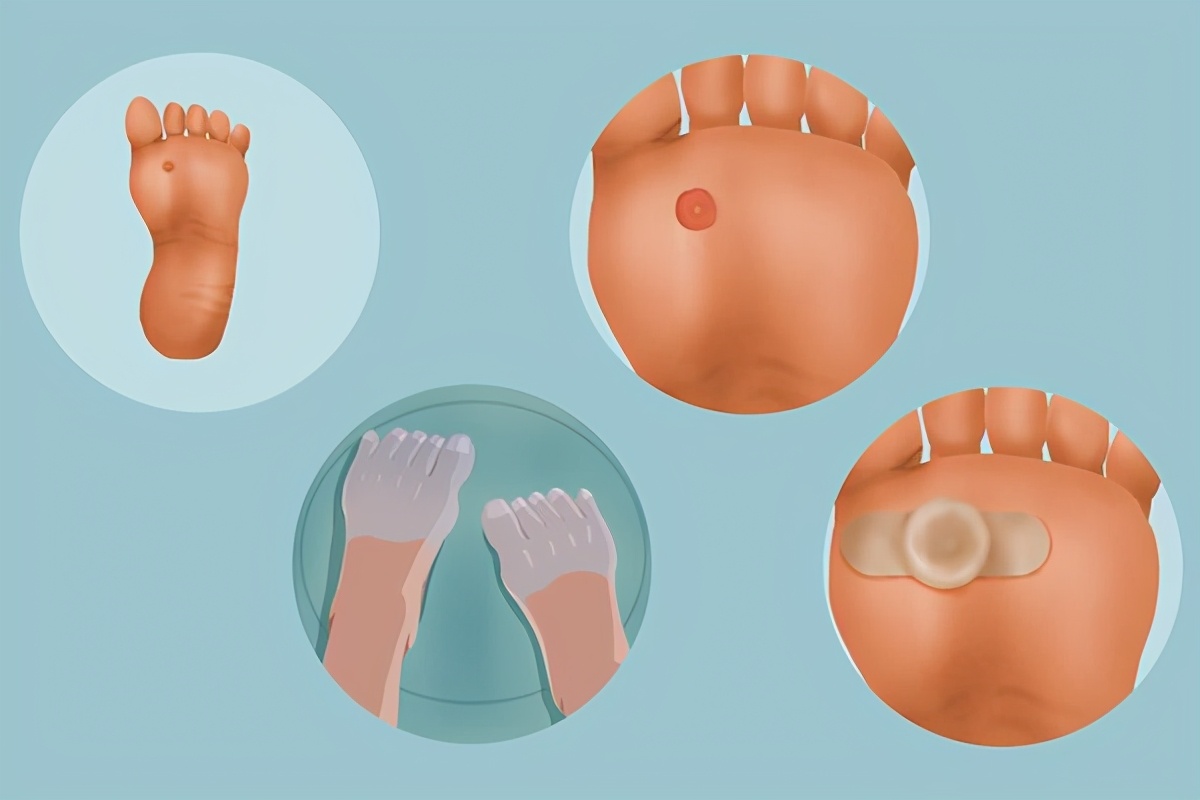 鸡眼怎么回事,鸡眼是怎么回事用什么药治疗