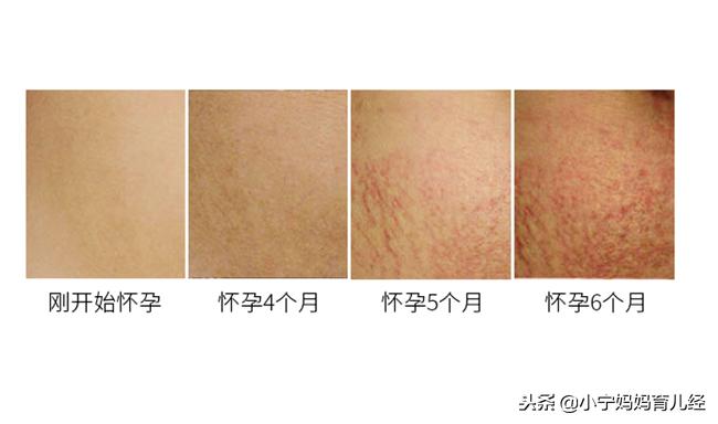 美丽孕妈不长妊娠纹，这3个好习惯，马上get起来