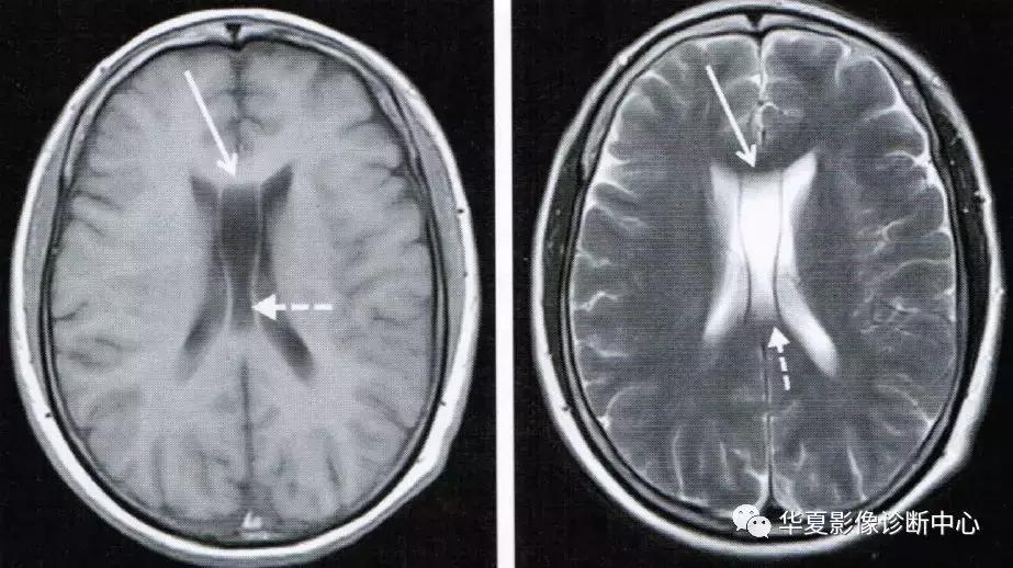 透明隔腔与透明囊肿鉴别,透明隔间腔与囊肿区别