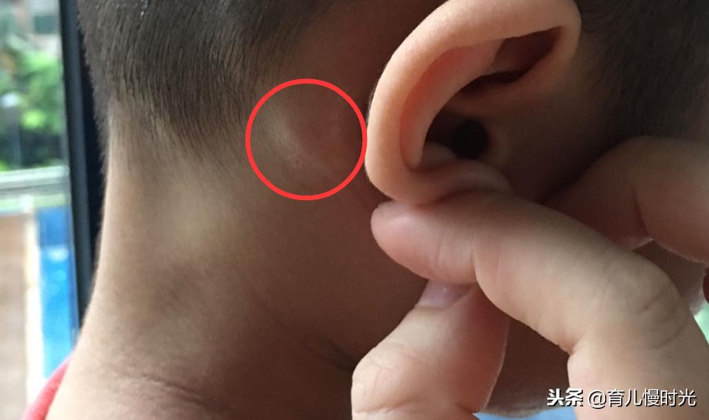 宝宝头上突然长了个硬疙瘩有点红,头上长了个软疙瘩怎么回事