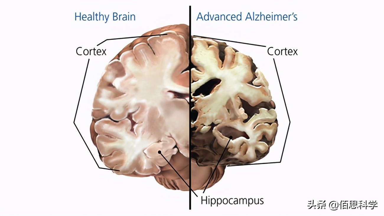 阿兹海默症跟失智症一样吗,阿兹海默病是帕金森吗