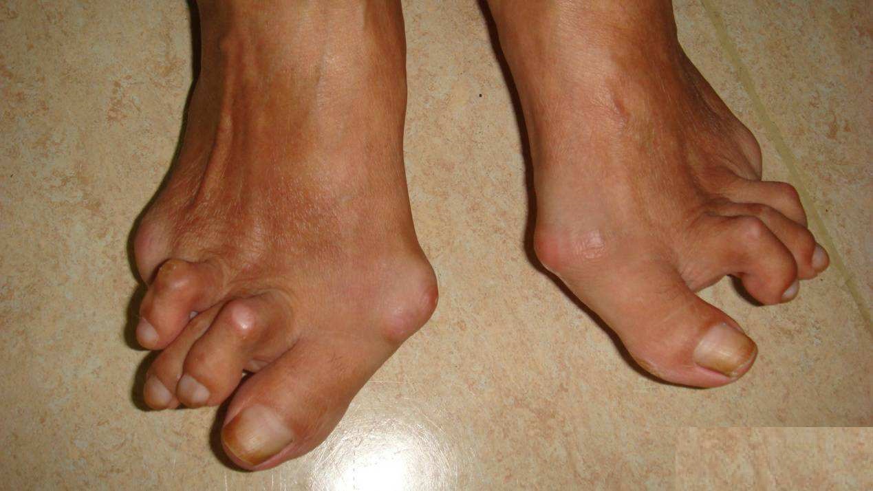 类风湿造成的关节变形可恢复吗？大多不行，有两种情况可以