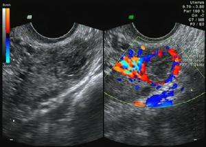 了解子宫肌瘤的病因是什么,你了解自己的子宫吗