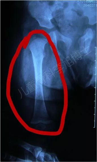 婴儿股骨骨折会有后遗症吗,六个月婴儿右股骨骨折