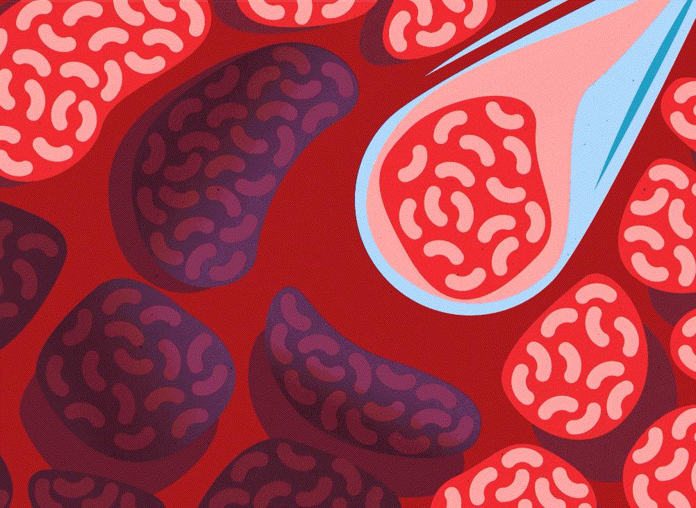 胰腺癌研究获重大突破,肝癌领域研究取得重大突破