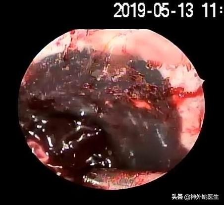 球囊扩张血肿怎么办,经皮穿刺脑血管腔内球囊成形术