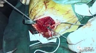 肩锁关节脱位手术后多久可以喝酒,肩锁关节脱位钢板内固定步骤记录