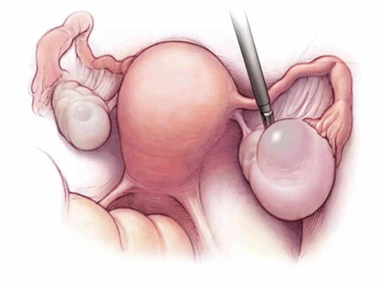 打了巧克力囊肿的针会影响怀孕吗,一侧巧克力囊肿怀孕的几率有多大