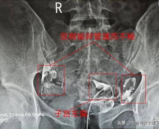 于萍：大夫，B超检查卵巢多囊样变，这是多囊卵巢综合征吗？